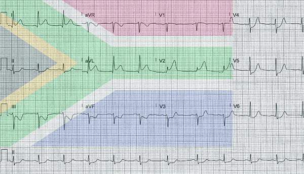 48-5 ECG Challenge - High Lateral MI flag sign-01.jpg