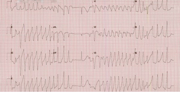 48-6 Torsades - Figure1.jpg