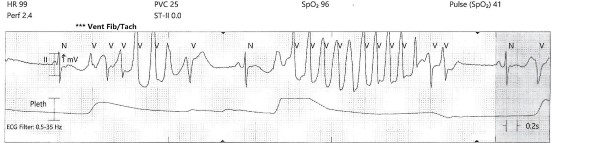 Torsades -1 - polymorphic-premature-ventricular.jpeg