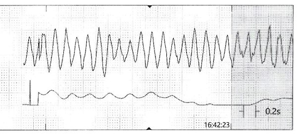 Torsades -2- torsades-de-pointes.jpeg