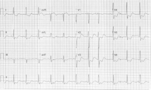 ECG Challenge Hypokalemia.jpg