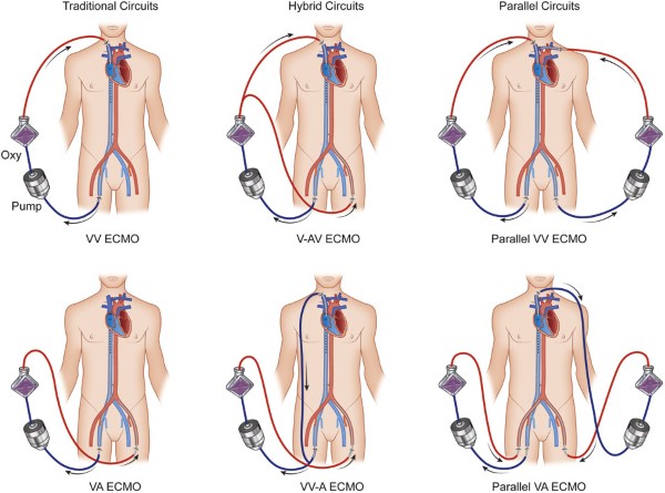 ECMO - Fig 3 circuits.jpg