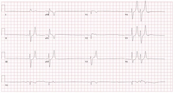 ECG Hyperkalemia.jpg