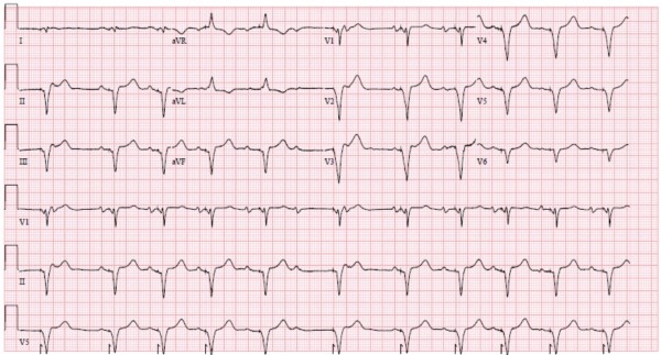 Leadless Pacemaker Image 1.jpg