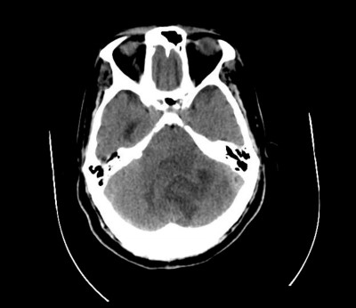 Brain Abscess Image 1.jpg