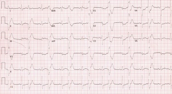 ECG Figure 1 Case EKG.jpeg