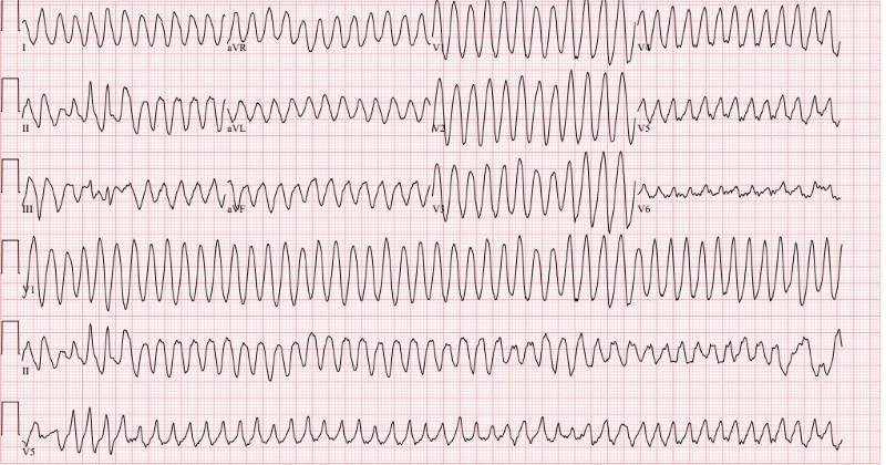 Cardiac Arrest Figure 3.jpg