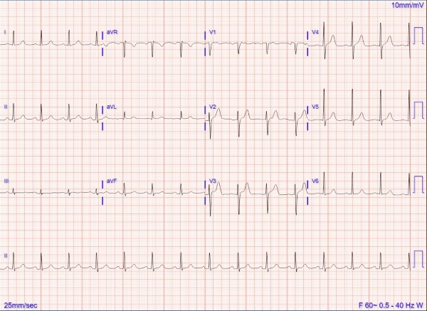 Bezold-Jarisch Reflex - Fig 1.jpg