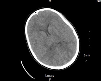 Influenza A - Fig 1 CT head.jpg