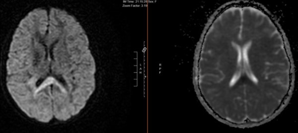 Influenza A - Fig 2 MRI brain.jpg