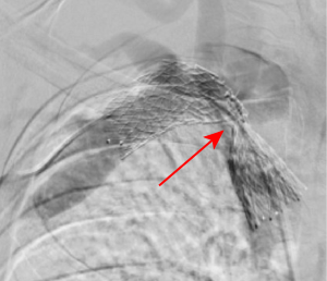Thoracic Outlet Syndrome - Image 2.png