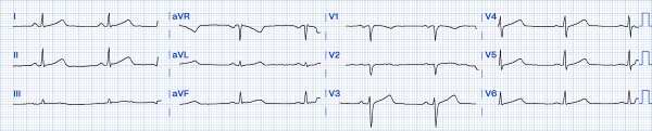 Alcohol-induced Tachycardia - Fig 2.png