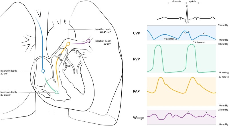 Crit Care Device - PAC 2 - Fig 2.jpeg