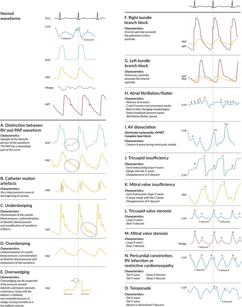 Crit Care Device - PAC 2 - Fig 3.jpeg