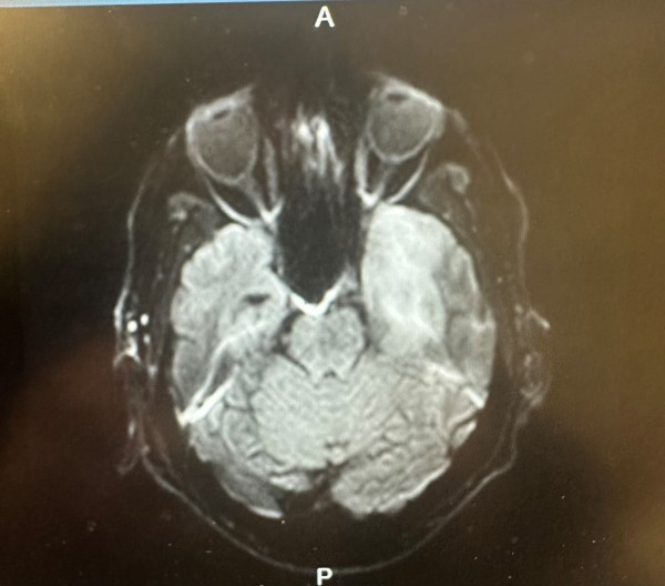 HSV Encephalitis - Image 2.jpg