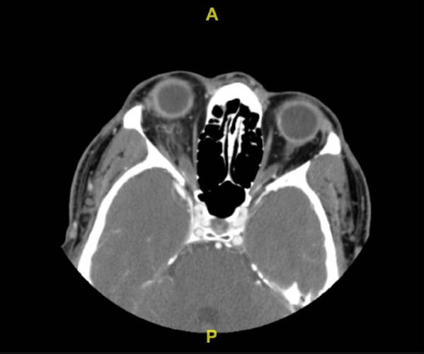 Orbital Cellulitis - Fig 1.jpg