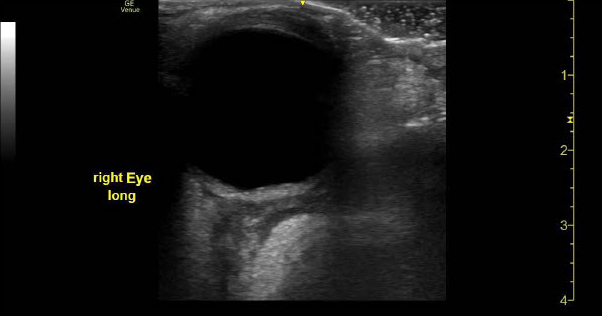 Orbital Cellulitis - Fig 2.jpg