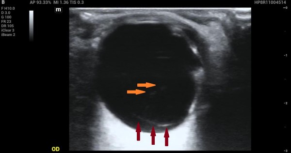 Vitreous Hemorrhage - Image 1.jpg
