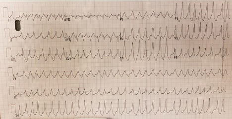 ECG Challenge - AFib with WPW (1).jpg
