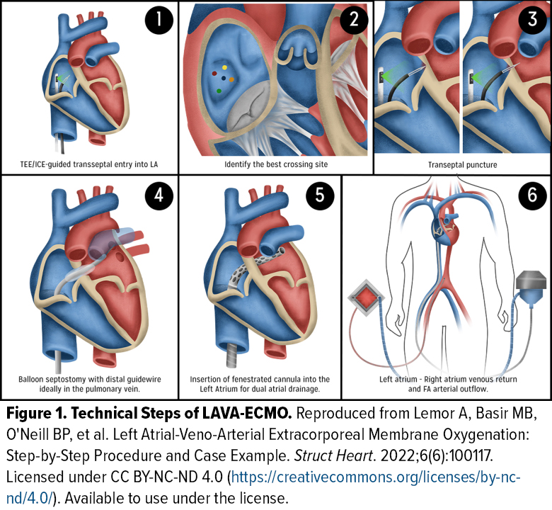 LAVA-ECMO.jpg