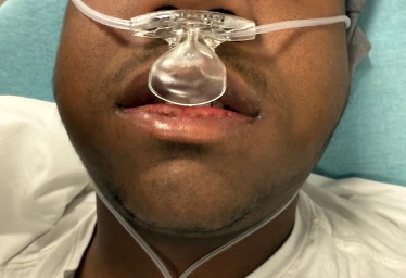 Figure 4: Bilateral buccal edema