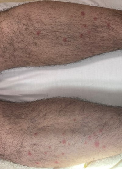 Behcet Figure 5 Rash.jpeg