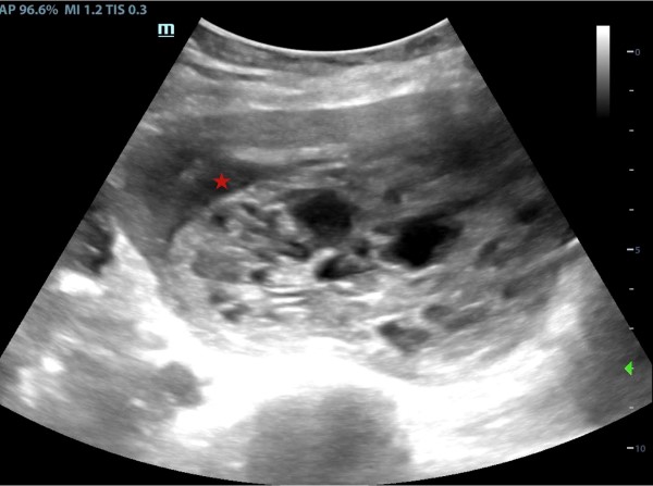 Molar Pregnancy - Fig 2.jpeg